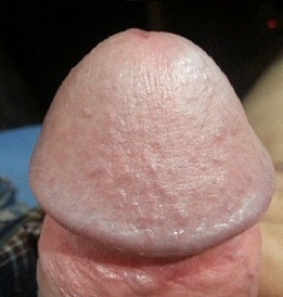 Photo du gland agrandi du pénis
