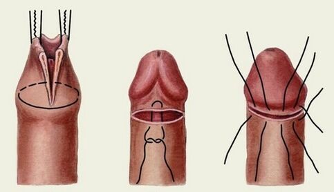 l'essence de la chirurgie d'agrandissement du pénis
