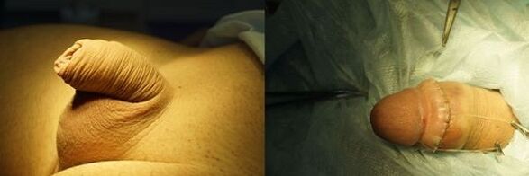 pénis avant et après chirurgie d'agrandissement