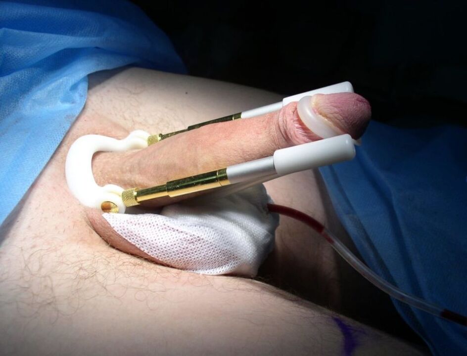 extenseur après chirurgie d'agrandissement du pénis