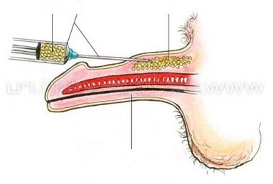 agrandissement du pénis par injection