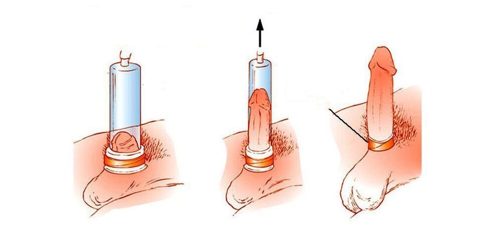 comment fonctionne une pompe à vide à pénis